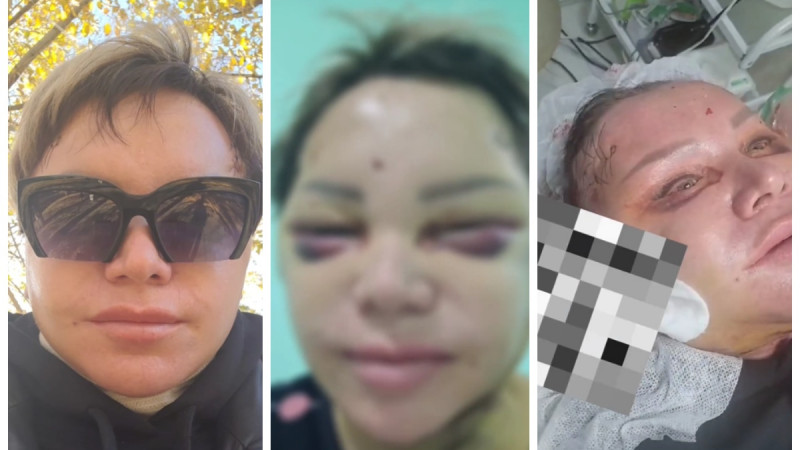 Женщина едва не умерла из-за косметологической процедуры в Кокшетау